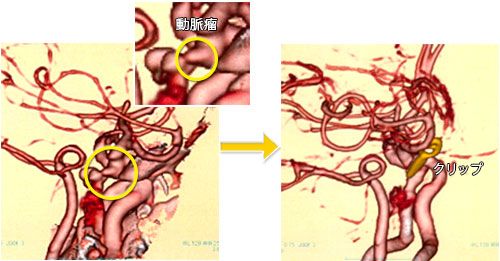 破裂脳動脈瘤(くも膜下出血)-2 右内頚動脈瘤