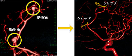破裂脳動脈瘤(くも膜下出血)-3 多発性前大脳動脈瘤