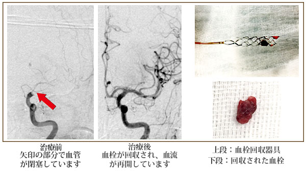 脳卒中が必要になるのはいつですか?