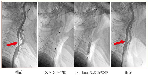 頸動脈ステント留置術