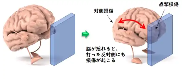 頭部外傷の各々の病態