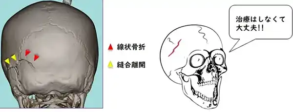 線状骨折