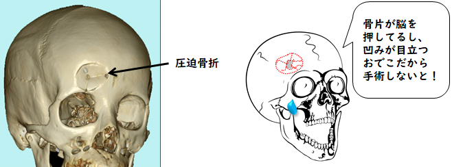 頭蓋骨 へこみ