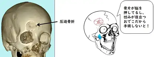 陥没骨折