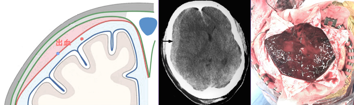 硬膜下血腫