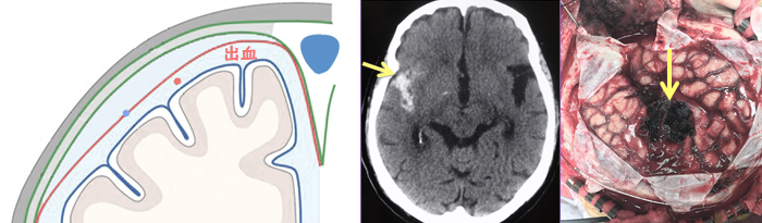 （外傷性）くも膜下出血