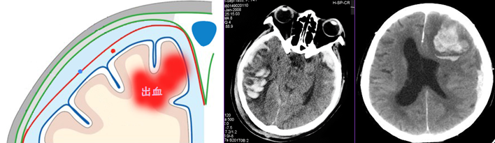脳内出血（脳挫傷）