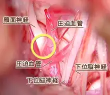 右顔面痙攣の症例01
