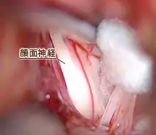 右顔面痙攣の症例03