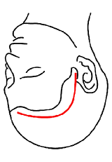 「前頭側頭部からアプローチする手術」で用いる皮膚切開