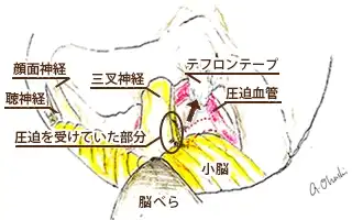 三叉神経痛の治療のイラスト
