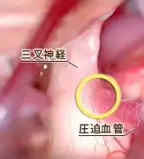 三叉神経痛01