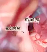 三叉神経痛02