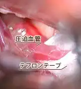 三叉神経痛03