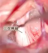 三叉神経痛04