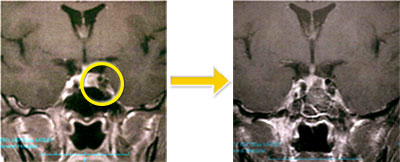 トルコ鞍部腫瘍-3 下垂体腺腫（プロラクチン産生腺腫）