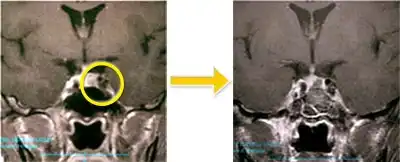 トルコ鞍部腫瘍-3 下垂体腺腫(プロラクチン産生腺腫)
