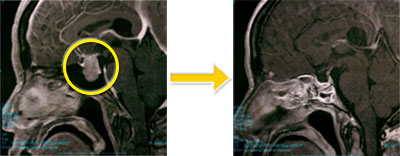トルコ鞍部腫瘍-4 下垂体腺腫（成長ホルモン産生腺腫）