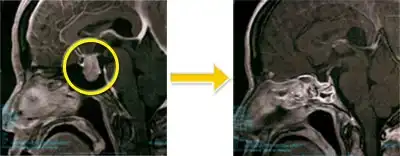 トルコ鞍部腫瘍-4 下垂体腺腫(成長ホルモン産生腺腫)
