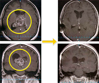 脳室内腫瘍-2 中枢神経細胞腫