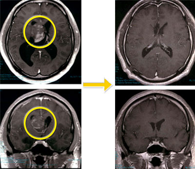 脳室内腫瘍-3 中枢神経細胞腫