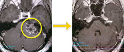 神経鞘腫-4 左聴神経鞘腫