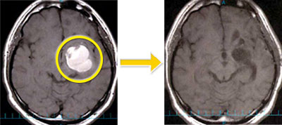 脳腫瘍MRI画像｜脳腫瘍｜脳神経外科｜新百合ヶ丘総合病院