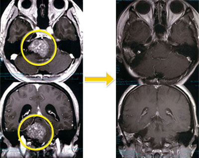 頭蓋底腫瘍-1 右錐体斜台部髄膜腫