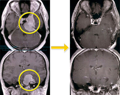 頭蓋底腫瘍-2 錐体斜台部髄膜腫