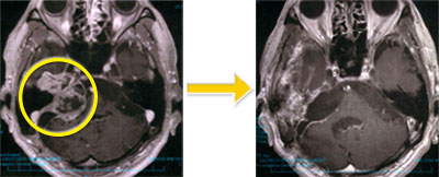 頭蓋底腫瘍-3 右聴神経腫瘍（再発例）