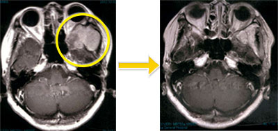 頭蓋底腫瘍-6 左側頭窩下髄膜腫(再発例）