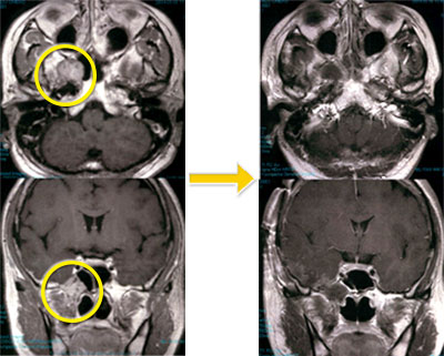 頭蓋底腫瘍-8 右Vidian神経鞘腫