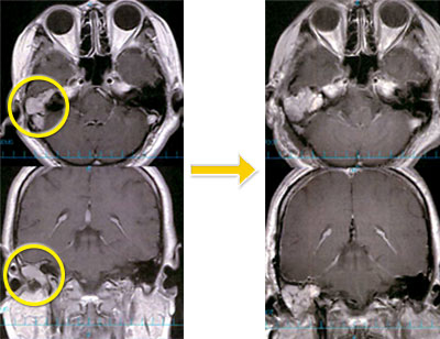 頭蓋底腫瘍-9 右顔面神経鞘腫
