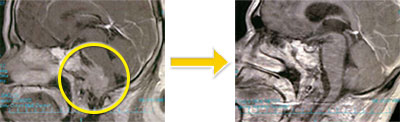 頭蓋底腫瘍-10 斜台-大孔部脊索腫