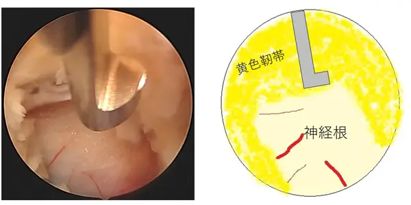 黄色靭帯の一部を開窓して、神経が走行する硬膜外腔に入る