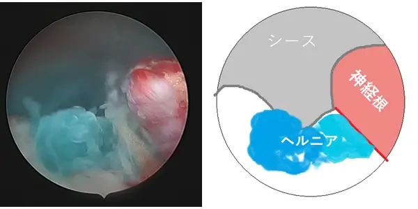 染色されたヘルニア