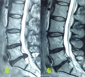 腰椎椎間板ヘルニアの症例