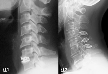 頸椎 対象疾患 治療法 脊椎脊髄末梢神経外科 低侵襲脊髄手術センター 新百合ヶ丘総合病院