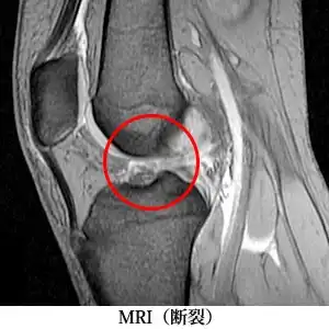 MRI（断裂）