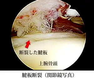 腱板断裂（関節鏡写真）