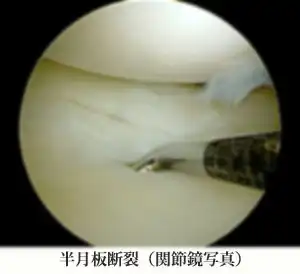 半月板断裂（関節鏡写真）