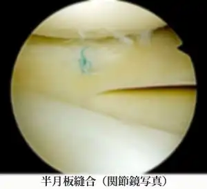 半月板縫合（関節鏡写真）
