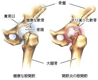 健康な股関節と関節炎の股関節