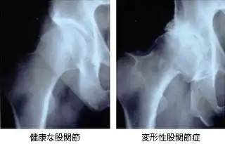 変形性股関節症