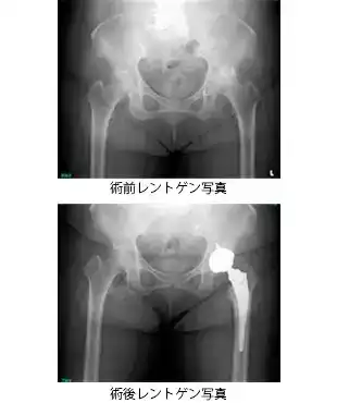 人工膝関節置換術レントゲン