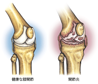 健康な膝関節と関節炎