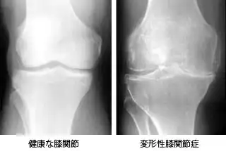 変形性膝関節症
