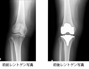 人工膝関節置換術レントゲン