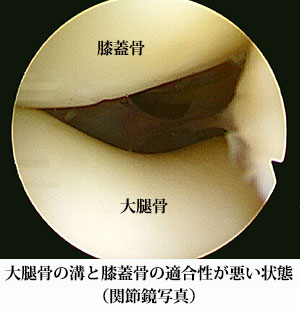 大腿骨の溝と膝蓋骨の適合性が悪い状態（関節鏡写真）