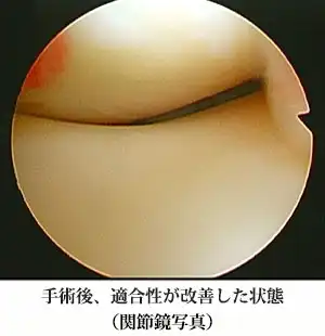 手術後、適合性が改善した状態（関節鏡写真）